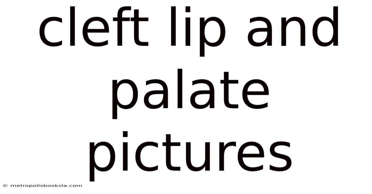 Cleft Lip And Palate Pictures